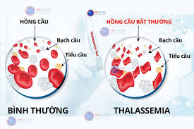 thalassemia